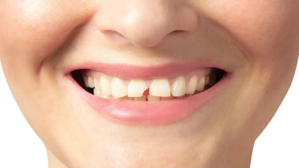 sonhar com dente quebrado