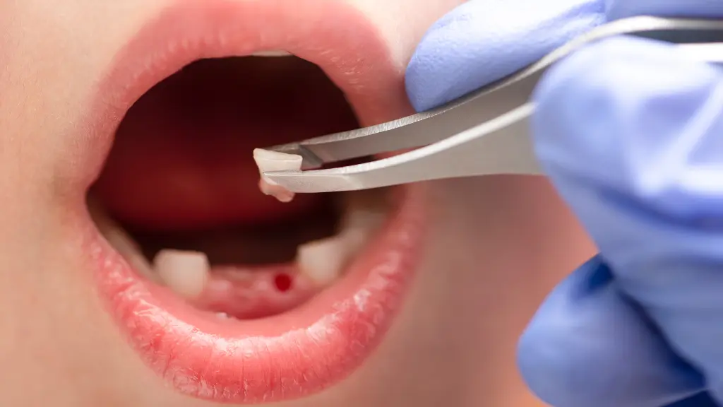 Sonhar com dente arrancado