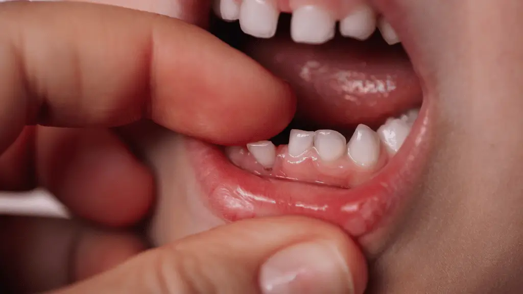 uma boca infantil mostrando um dente de leite prestes a cair, simbolizando mudança, crescimento e o significado de sonhar com dente caindo.